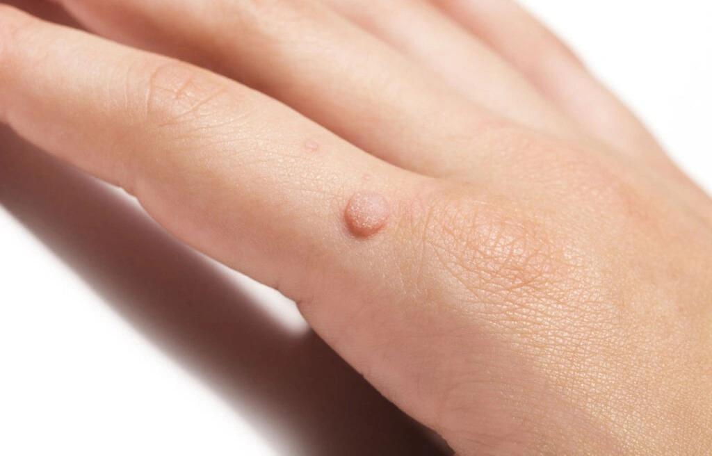 Wart Removal